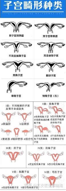 子宫畸形能怀孕吗？ 知乎