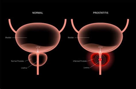 Prostatitis Manchester Urology Associates Pa