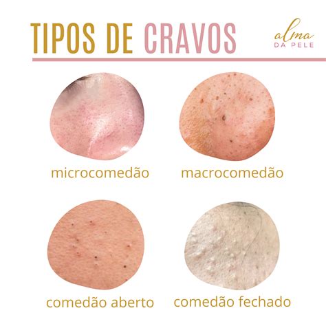 Tipos De Cravos Na Pele Comed O Cravos Cravos Na Pele