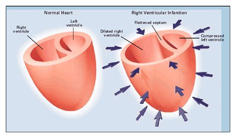 Reperfusion For Right Ventricular Infarction New England Journal Of