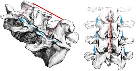 Sap Principle Guided Free Hand Technique A Secret For T To S Pedicle