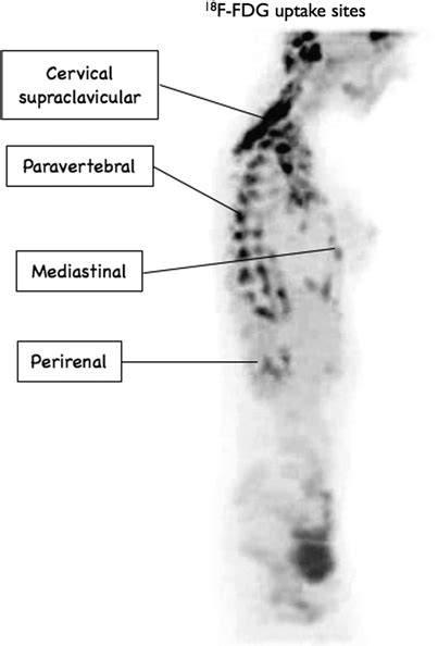 Brown Adipose Tissue Bat In Humans Demonstrated By Positron Emission