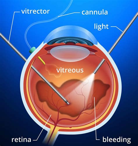 Vitrectomy Surgery Indications Risks And Vitrectomy Recovery Time