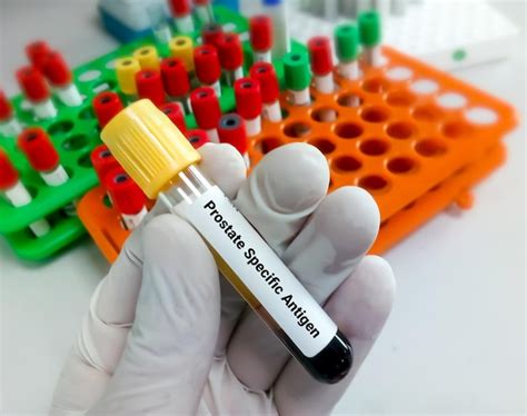 Premium Photo Blood Sample For Prostate Specific Antigen Or Psa Test