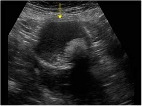 Subcutaneous Dermoid Cyst Ultrasound