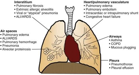 Acute Hypoxemic Respiratory Failure And Ards Thoracic Key