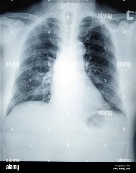 Healthy Lung Xray High Resolution Stock Photography And Images Alamy