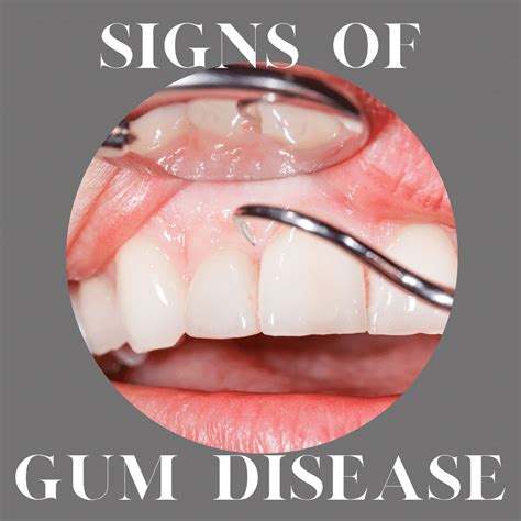 Signs Of Gum Disease Covington Dental