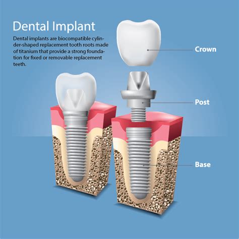 What Are Dental Implants Dental Innovations Of Virginia