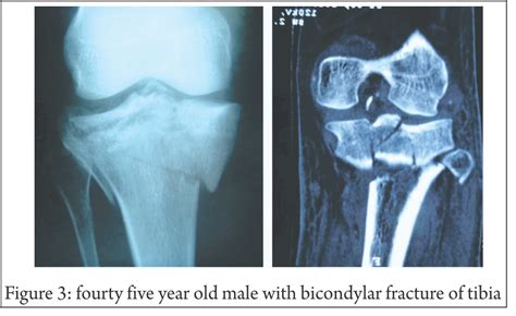 Tibia eminence fracture Archives - Trauma International