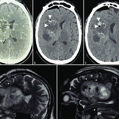 A Preoperative Stereotactic Enhanced Ct Showing An Expansive Lesion Download Scientific