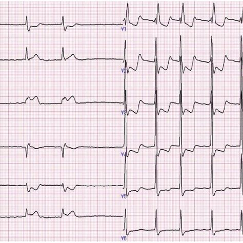 3 Anterior ST-segment-elevation ECG. More marked ST-segment elevation V... | Download Scientific ...