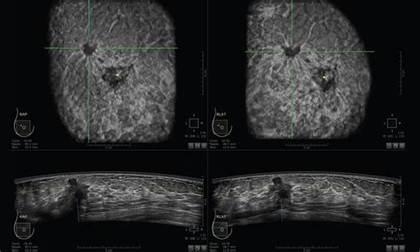 Ultrasound Reimbursement For Supplemental Breast Screening Empowered