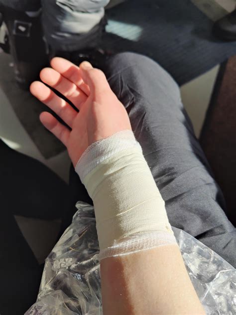 My tendons broken before my bones : r/Neverbrokeabone