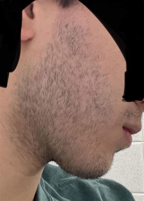 9 Weeks In Before And After One Week Without Shaving Any Thoughts On