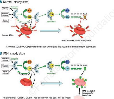 Figure 1 From Paroxysmal Nocturnal Hemoglobinuria And Eculizumab