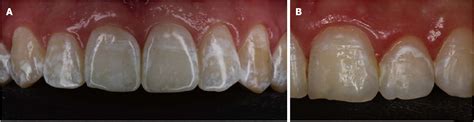 Figure 1 From Enamel Microabrasion An Overview Of Clinical And