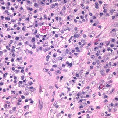 Inflammation infiltrating into the parenchyma of the brain and... | Download Scientific Diagram