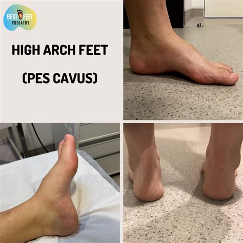 High Arch Feet Pes Cavus 시드니 좋은 발병원