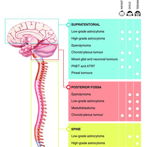 Pediatric Brain Tumour Types And Respective Locations That Are Most