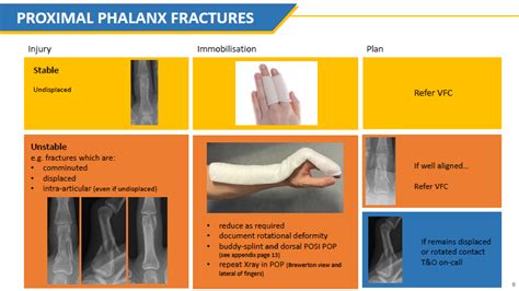 Proximal phalanx fractures | Mtwortho