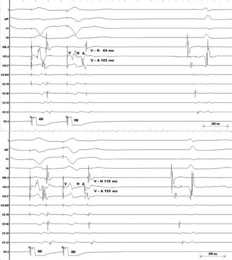 A Represents Surface Ecg I Avf V V And Intracardiac