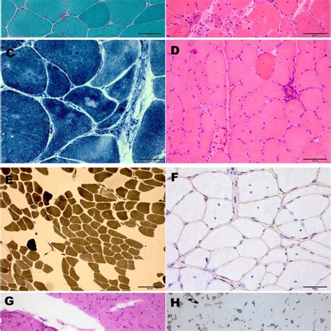 Weakness Distribution In This Cohort Of Congenital Myasthenic Syndrome