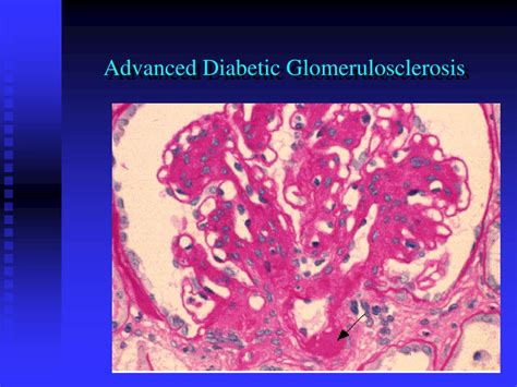 Ppt Diabetic Nephropathy Powerpoint Presentation Free Download Id