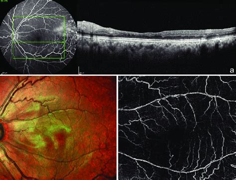 A Sd Oct Image Of The Left Eye Through The Area Of Retinal Thinning