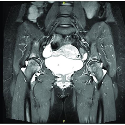 A Coronal Plane T 2 Weighted MRI Of Pelvis And Hip Joints Of Case 1