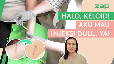 HILANGKAN KELOID BISA DI ZAP CLINIC YouTube