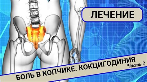 БОЛИТ КОПЧИК. Кокцигодиния. Лечение. (Часть 2) - YouTube