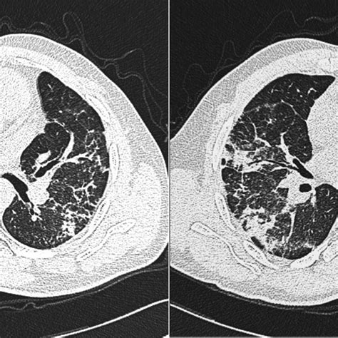 Open lung biopsy, 200 × magnification, 2008. | Download Scientific Diagram