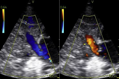 Subcostal Long Axis Image With Color Doppler Of The Hepatic Veins