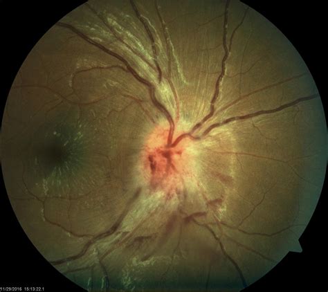 Papilledema Or Pseudopapilledema Sharpen Your Image Interpretation