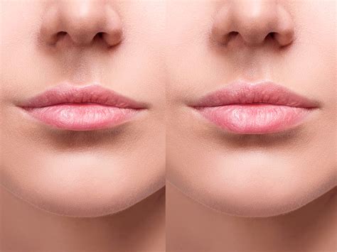 Preenchimento Labial Como Feito Valor E Resultados Dream