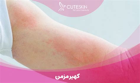 کهیر مزمن چیست؟ دلایل، علائم و روش درمان کیوت مگ Cuteskin