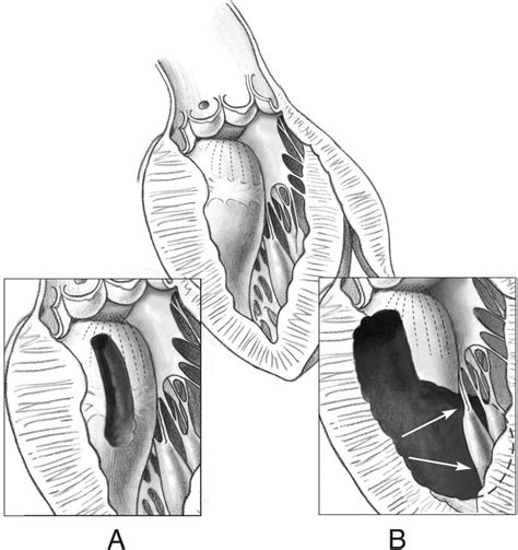 Septal Myectomy For Obstructive Hypertrophic Cardiomyopathy Operative