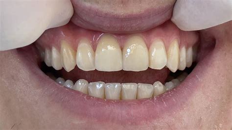 Veneers Wien Dr Lukas Hallmann