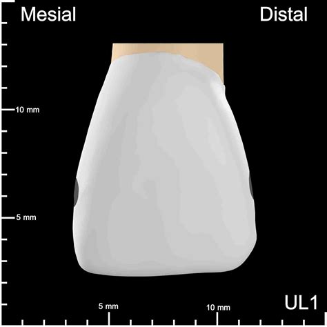 Ul Mesial And Distal Decay K Teeth