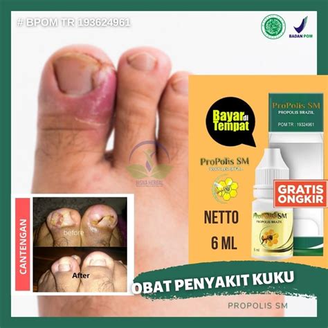 Jual Obat Tetes Jempol Kaki Bernanah Akibat Cantengan Penghilang