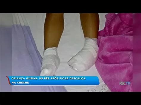 Menina Sofre Queimaduras De Segundo Grau Nos P S Em Creche De Balne Rio