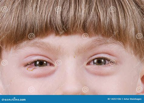 Conjunctivitis Ill Allergic Eyes Stock Photo Image Of