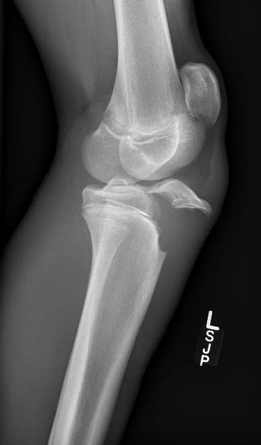 Tibial Tuberosity Fracture