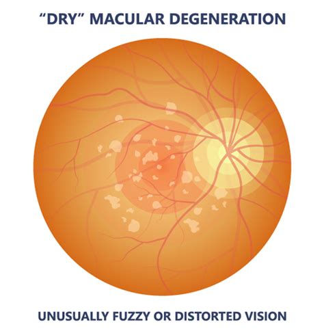 Dry Vs Wet Macular Degeneration