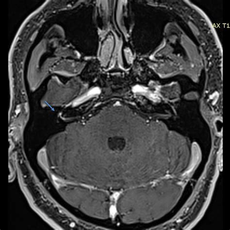 Axial Slice Of T D Vibe Fatsat Gadolinium Enhanced Brain Mri Sequence