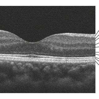 SD OCT Findings Of The Normal Human Macula RNFL Retinal Nerve Fiber