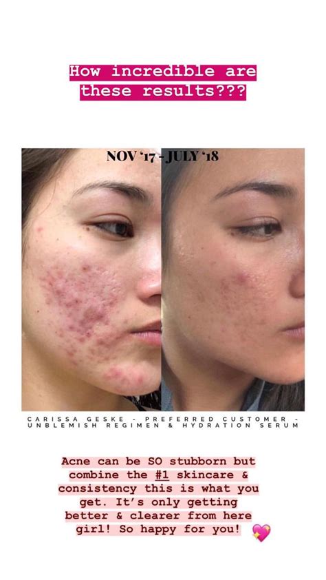 Unblemish Unblemish Rodan And Fields Only Getting Better