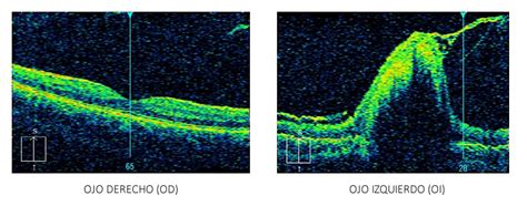 Hamartoma Retiniano Diagnóstico Diferencial Clínica Rementería