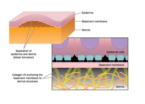 Causes Treatment And Prevention Of Blisters Caruso Foot And Ankle